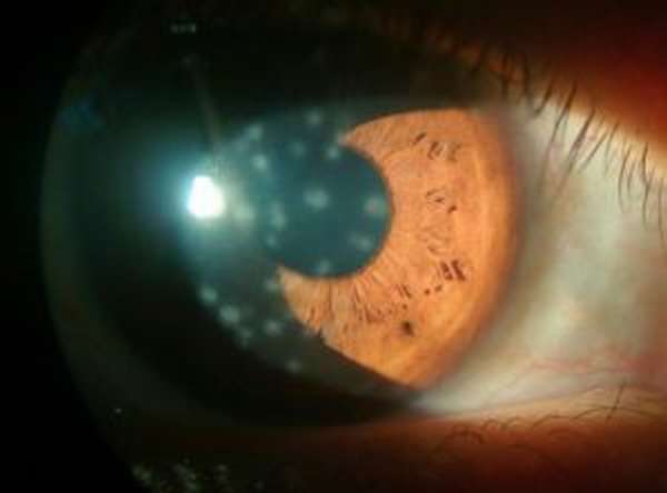 фото вирусного кератита глаза